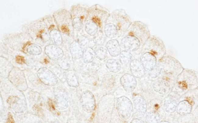 GBF1 Antibody - Detection of Human GBF1 by Immunohistochemistry. Sample: FFPE section of human prostate carcinoma. Antibody: Affinity purified rabbit anti-GBF1 used at a dilution of 1:200 (1 Detection: DAB.