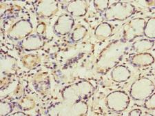 GBF1 Antibody - Immunohistochemistry of paraffin-embedded human gastric cancer at dilution 1:100
