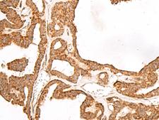 GBGT1 Antibody - Immunohistochemistry of paraffin-embedded Human thyroid cancer tissue  using GBGT1 Polyclonal Antibody at dilution of 1:40(×200)
