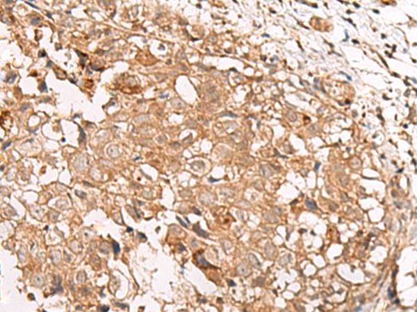 GBGT1 Antibody - Immunohistochemistry of paraffin-embedded Human breast cancer tissue  using GBGT1 Polyclonal Antibody at dilution of 1:40(×200)