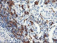 GBP1 Antibody - IHC of paraffin-embedded Carcinoma of Human lung tissue using anti-GBP1 mouse monoclonal antibody. (Heat-induced epitope retrieval by 10mM citric buffer, pH6.0, 100C for 10min).