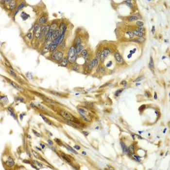 GBP1 Antibody - Immunohistochemistry of paraffin-embedded human liver cancer tissue.