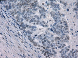 GBP2 Antibody - Immunohistochemical staining of paraffin-embedded Adenocarcinoma of ovary tissue using anti-GBP2 mouse monoclonal antibody. (Dilution 1:50).