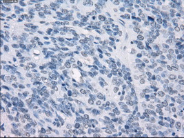 GBP2 Antibody - Immunohistochemical staining of paraffin-embedded Carcinoma of bladder tissue using anti-GBP2 mouse monoclonal antibody. (Dilution 1:50).