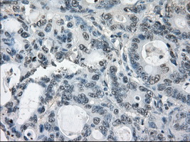 GBP2 Antibody - Immunohistochemical staining of paraffin-embedded Adenocarcinoma of colon tissue using anti-GBP2 mouse monoclonal antibody. (Dilution 1:50).