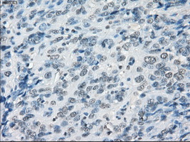 GBP2 Antibody - Immunohistochemical staining of paraffin-embedded Carcinoma of bladder tissue using anti-GBP2 mouse monoclonal antibody. (Dilution 1:50).