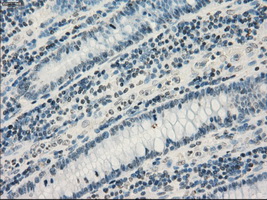 GBP2 Antibody - Immunohistochemical staining of paraffin-embedded Adenocarcinoma of colon tissue using anti-GBP2 mouse monoclonal antibody. (Dilution 1:50).