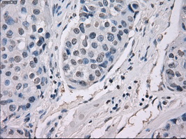 GBP2 Antibody - IHC of paraffin-embedded Adenocarcinoma of breast tissue using anti-GBP2 mouse monoclonal antibody. (Dilution 1:50).
