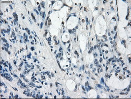 GBP2 Antibody - IHC of paraffin-embedded Adenocarcinoma of colon tissue using anti-GBP2 mouse monoclonal antibody. (Dilution 1:50).