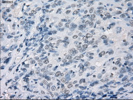 GBP2 Antibody - IHC of paraffin-embedded Carcinoma of bladder tissue using anti-GBP2 mouse monoclonal antibody. (Dilution 1:50).
