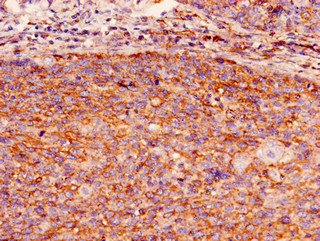 GBP2 Antibody - Immunohistochemistry of paraffin-embedded human pancreatic cancer using GBP2 Antibody at dilution of 1:100