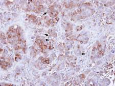 GBP3 Antibody - IHC of paraffin-embedded NCIN87 xenograft using Guanylate-binding protein 3 antibody at 1:100 dilution.