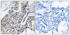 GBP4 / Mpa2 Antibody - Peptide - + Immunohistochemistry analysis of paraffin-embedded human breast carcinoma tissue using GBP4 antibody.