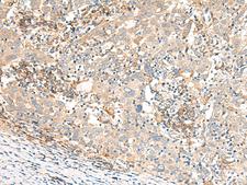 GBP4 / Mpa2 Antibody - Immunohistochemistry of paraffin-embedded Human cervical cancer tissue  using GBP4 Polyclonal Antibody at dilution of 1:30(×200)