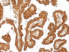 GBP4 / Mpa2 Antibody - Immunohistochemistry of paraffin-embedded Human thyroid cancer tissue  using GBP4 Polyclonal Antibody at dilution of 1:45(×200)