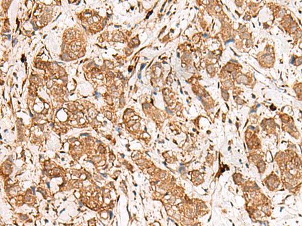 GBP4 / Mpa2 Antibody - Immunohistochemistry of paraffin-embedded Human breast cancer tissue  using GBP4 Polyclonal Antibody at dilution of 1:45(×200)