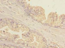 GBP5 Antibody - Immunohistochemistry of paraffin-embedded human prostate cancer using antibody at dilution of 1:100.