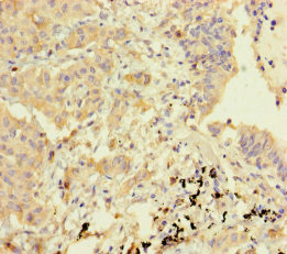 GBP6 Antibody - Immunohistochemistry of paraffin-embedded human lung cancer using GBP6 Antibody at dilution of 1:100