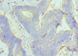 GC / Vitamin D-Binding Protein Antibody - Immunohistochemistry of paraffin-embedded human colon cancer using antibody at 1:100 dilution.