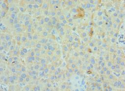 GC / Vitamin D-Binding Protein Antibody - Immunohistochemistry of paraffin-embedded human liver cancer using antibody at 1:100 dilution.