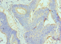 GC / Vitamin D-Binding Protein Antibody - Immunohistochemistry of paraffin-embedded human colon cancer using GC Antibody at dilution of 1:100