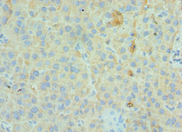 GC / Vitamin D-Binding Protein Antibody - Immunohistochemistry of paraffin-embedded human liver cancer using GC Antibody at dilution of 1:100