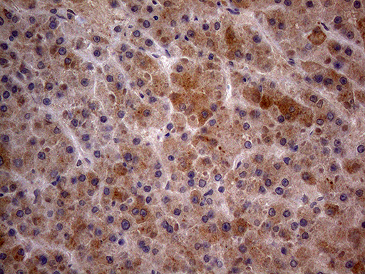 GC / Vitamin D-Binding Protein Antibody - Immunohistochemical staining of paraffin-embedded Carcinoma of Human liver tissue using anti-GC mouse monoclonal antibody. (Heat-induced epitope retrieval by 1mM EDTA in 10mM Tris buffer. (pH8.5) at 120°C for 3 min. (1:150)