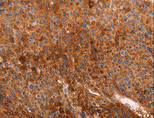 GC / Vitamin D-Binding Protein Antibody - Immunohistochemistry of paraffin-embedded Human liver cancer using GC Polyclonal Antibody at dilution of 1:40.