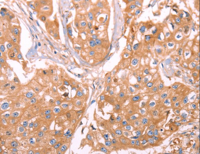 GC / Vitamin D-Binding Protein Antibody - Immunohistochemistry of paraffin-embedded Human breast cancer using GC Polyclonal Antibody at dilution of 1:40.