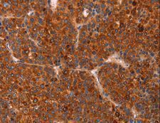 GC / Vitamin D-Binding Protein Antibody - Immunohistochemistry of paraffin-embedded Human thyroid cancer using GC Polyclonal Antibody at dilution of 1:30.