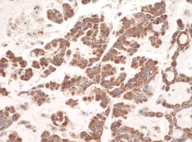 GC1qR / C1QBP Antibody - Detection of Human C1QBP by Immunohistochemistry. Sample: FFPE section of human lung carcinoma. Antibody: Affinity purified rabbit anti-C1QBP used at a dilution of 1:1000 (1 Detection: Vector ImmPACT NovaRED.