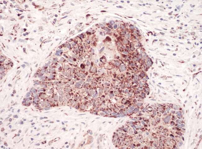 GC1qR / C1QBP Antibody - Detection of Human C1QBP by Immunohistochemistry. Sample: FFPE section of human lung carcinoma. Antibody: Affinity purified rabbit anti-C1QBP used at a dilution of 1:200 (1 Detection: Vector ImmPACT NovaRED.