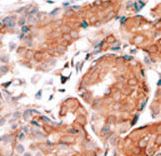 GCAP / GUCA1A Antibody - Formalin-fixed and paraffin-embedded human cancer tissue reacted with the primary antibody, which was peroxidase-conjugated to the secondary antibody, followed by DAB staining. This data demonstrates the use of this antibody for immunohistochemistry; clinical relevance has not been evaluated. BC = breast carcinoma; HC = hepatocarcinoma.