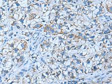 GCAP / GUCA1A Antibody - Immunohistochemistry of paraffin-embedded Human liver cancer tissue  using GUCA1A Polyclonal Antibody at dilution of 1:50(×200)