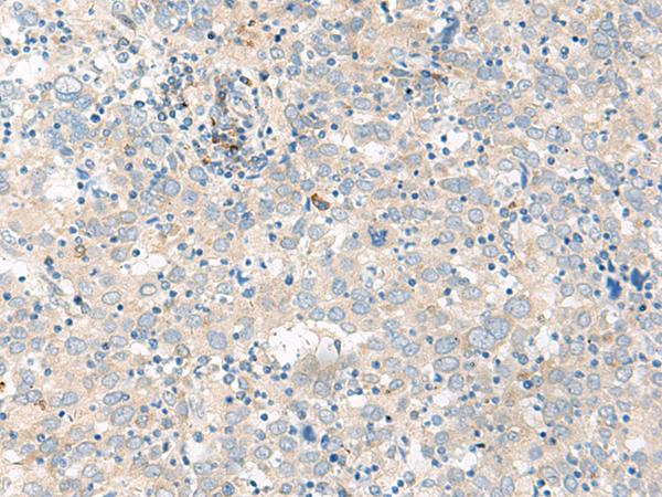 GCAP2 / GUCA1B Antibody - Immunohistochemistry of paraffin-embedded Human cervical cancer tissue  using GUCA1B Polyclonal Antibody at dilution of 1:45(×200)