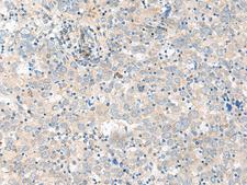 GCAP2 / GUCA1B Antibody - Immunohistochemistry of paraffin-embedded Human cervical cancer tissue  using GUCA1B Polyclonal Antibody at dilution of 1:45(×200)