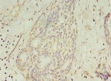 GCC1 / GCC88 Antibody - Immunohistochemistry of paraffin-embedded human breast cancer at dilution 1:100