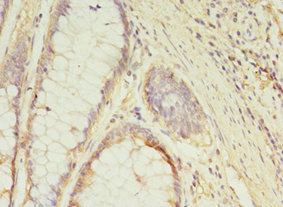 GCC1 / GCC88 Antibody - Immunohistochemistry of paraffin-embedded human colon cancer at dilution 1:100