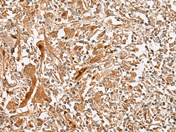 GCC2 Antibody - Immunohistochemistry of paraffin-embedded Human liver cancer tissue  using GCC2 Polyclonal Antibody at dilution of 1:45(×200)