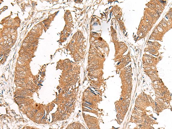 GCC2 Antibody - Immunohistochemistry of paraffin-embedded Human colorectal cancer tissue  using GCC2 Polyclonal Antibody at dilution of 1:50(×200)