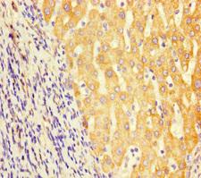 GCD / GCDH Antibody - Immunohistochemistry of paraffin-embedded human liver cancer using GCDH Antibody at dilution of 1:100