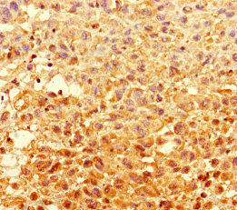 GCD / GCDH Antibody - Immunohistochemistry of paraffin-embedded human melanoma using GCDH Antibody at dilution of 1:100