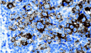 GCET2 / HGAL Antibody - Positive staining of HGAL with Anti-HGAL Monoclonal Antibody in classic Hodgkin lymphoma.