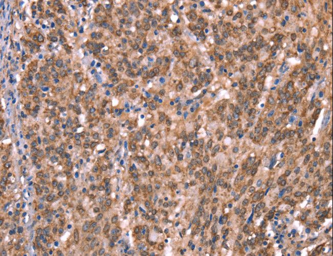 GCET2 / HGAL Antibody - Immunohistochemistry of paraffin-embedded Human liver cancer using GCSAM Polyclonal Antibody at dilution of 1:40.