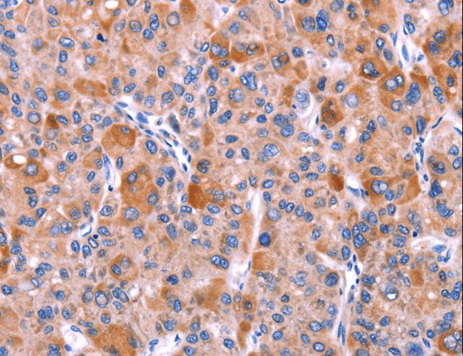 GCG / Glucagon Antibody - Immunohistochemistry of paraffin-embedded Human liver cancer using GCG Polyclonal Antibody at dilution of 1:40.