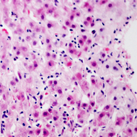 GCGR / Glucagon Receptor Antibody - Immunohistochemical analysis of Glucagon Receptor staining in human liver cancer formalin fixed paraffin embedded tissue section. The section was pre-treated using heat mediated antigen retrieval with sodium citrate buffer (pH 6.0). The section was then incubated with the antibody at room temperature and detected using an HRP conjugated compact polymer system. AEC was used as the chromogen. The section was then counterstained with hematoxylin and mounted with DPX.
