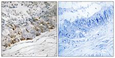 GCHFR Antibody - Immunohistochemistry analysis of paraffin-embedded human colon carcinoma tissue, using GCHFR Antibody. The picture on the right is blocked with the synthesized peptide.