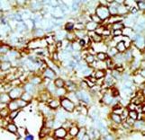 GCK / Germinal Center Kinase Antibody - Formalin-fixed and paraffin-embedded human cancer tissue reacted with the primary antibody, which was peroxidase-conjugated to the secondary antibody, followed by AEC staining. This data demonstrates the use of this antibody for immunohistochemistry; clinical relevance has not been evaluated. BC = breast carcinoma; HC = hepatocarcinoma.