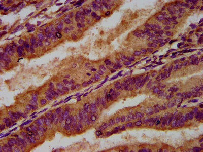 GCK / Germinal Center Kinase Antibody - Immunohistochemistry Dilution at 1:500 and staining in paraffin-embedded human endometrial cancer performed on a Leica BondTM system. After dewaxing and hydration, antigen retrieval was mediated by high pressure in a citrate buffer (pH 6.0). Section was blocked with 10% normal Goat serum 30min at RT. Then primary antibody (1% BSA) was incubated at 4°C overnight. The primary is detected by a biotinylated Secondary antibody and visualized using an HRP conjugated SP system.