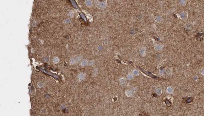 GCK / Germinal Center Kinase Antibody - 1:100 staining human brain carcinoma tissue by IHC-P. The sample was formaldehyde fixed and a heat mediated antigen retrieval step in citrate buffer was performed. The sample was then blocked and incubated with the antibody for 1.5 hours at 22°C. An HRP conjugated goat anti-rabbit antibody was used as the secondary.